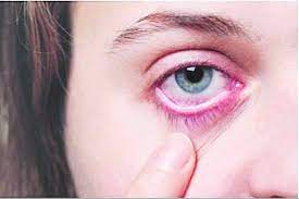 Three children lose eyes in Mumbai due to mucormycosis