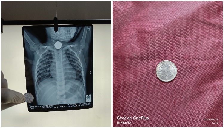 A three-year-old girl swallowed a rupee coin, pulled out two hours later