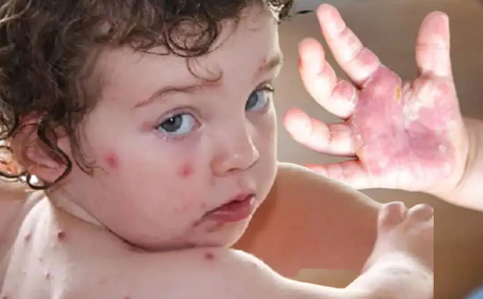Parents beware : Monkeypox-like rash; The risk of tomato fever infection in children is more...!