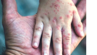 10 deaths due to measles in Mumbai, number of measles infected to 208