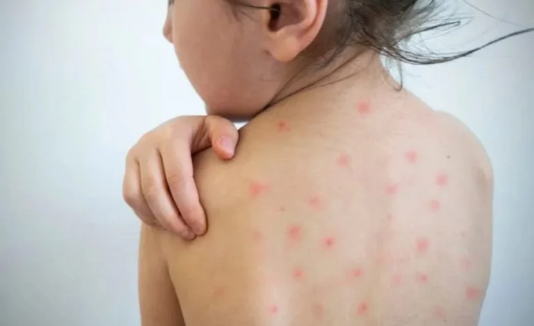 Task force orders: Now even measles patients will be quarantined