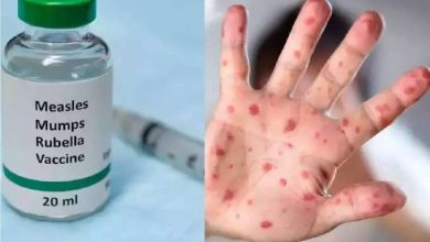 Terrible outbreak of measles in Maharashtra after Corona, these initial symptoms are dangerous, what to do