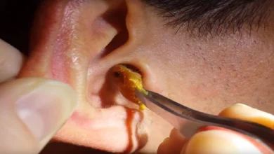 Accumulated earwax...take this easy remedy...