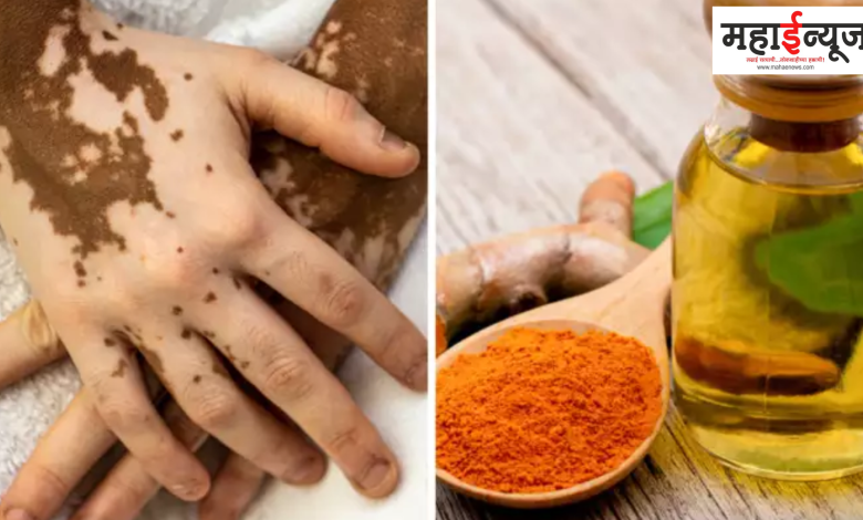 Turmeric, oil, all white spots, without delay, doctor, 4 remedies,