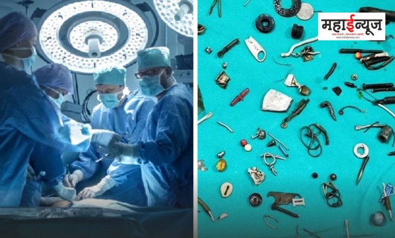 Over 100 items like earphones, lockets, screws came out of the patient's stomach